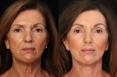 Ginger: The Natural Secret to Ageless Skin—A Botox Alternative You Must Try!