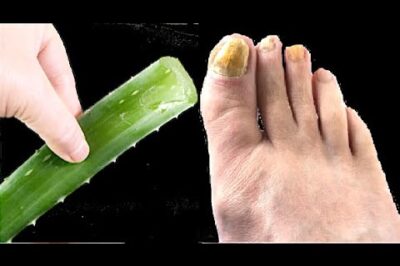 A Natural Treatment for Nail Fungus with This Nature’s Finest!!!!!!!!!